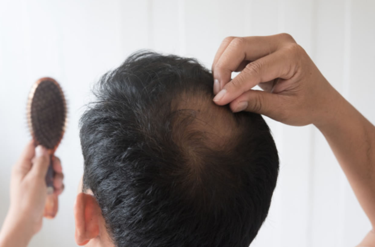 Alopecia