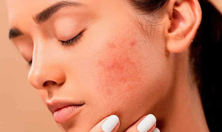Dermatitis