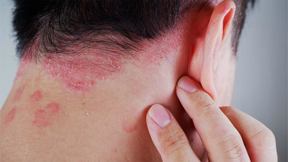 Psoriasis