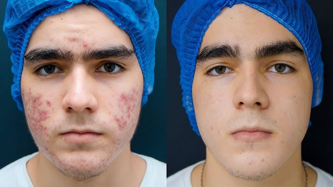 saliderm